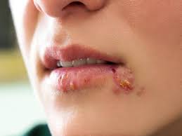 Herpes Disease Symptoms and Remedies