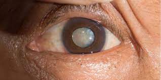 Include these 4 things in your diet to prevent cataracts
