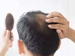 3 Effective Remedies for Baldness