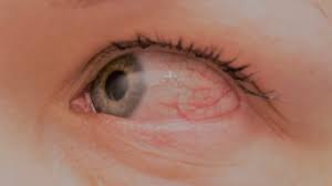 Eye conjunctivitis know the symptoms and remedies