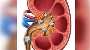 Do some simple home remedies for kidney stones
