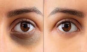 Apply curd to remove dark circles under the eyes
