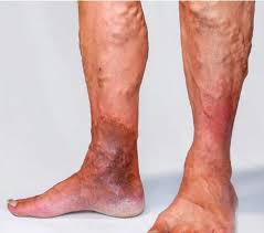 What are Varicose Veins