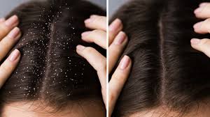 Home Remedies to Get Rid of Dandruff