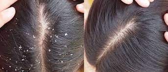 Applying aloe vera gel on the hair stops hair fall and helps in hair growth and makes the hair soft and strong