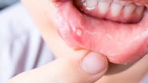 Causes symptoms and remedies for frequent mouth ulcers