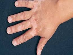 How does code or white spot disease occur Are there any solutions for this