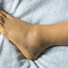 Why do you get swelling on your feet