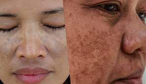 What is the exact cause of acne and what is the treatment