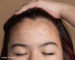 Follow this remedy if you are suffering from hormonal acne problem