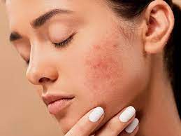 Prevent summer acne