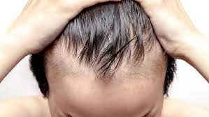Follow these remedies to stop hair loss